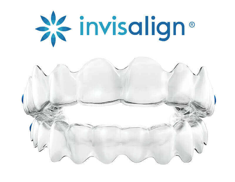 Invisalign Zahnfehlstellungskorrektur