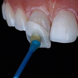 Keramische Veneers (Verblendschalen)