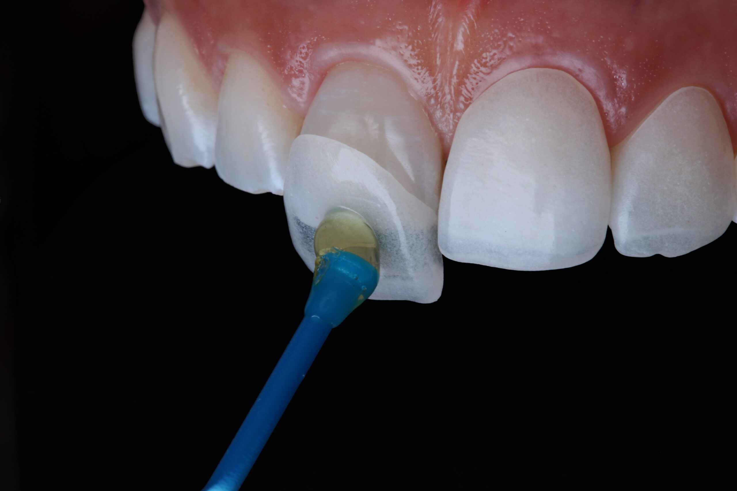 Keramische Veneers (Verblendschalen)